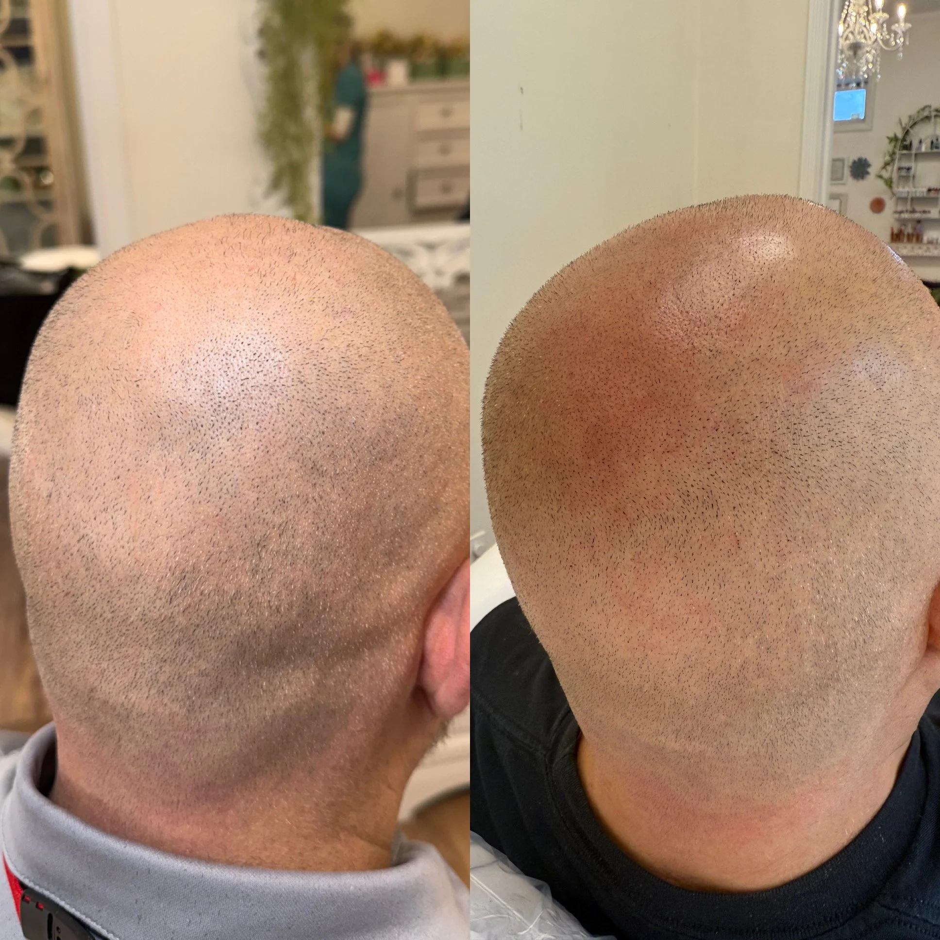 Scalp Micropigmentation Before and After at Kinesis Studio in Fairfield CT