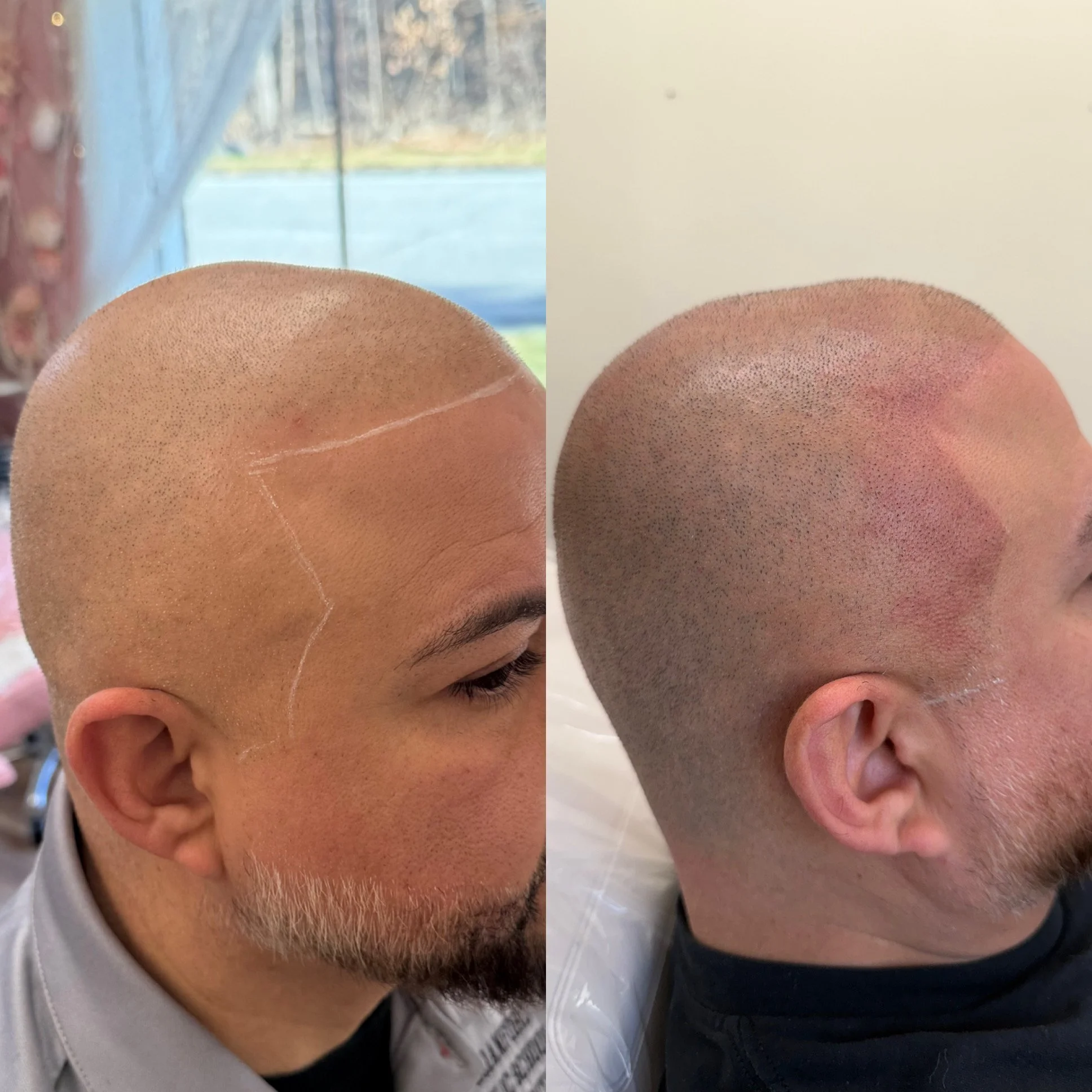 Scalp Micropigmentation Before and After at Kinesis Studio in Fairfield CT