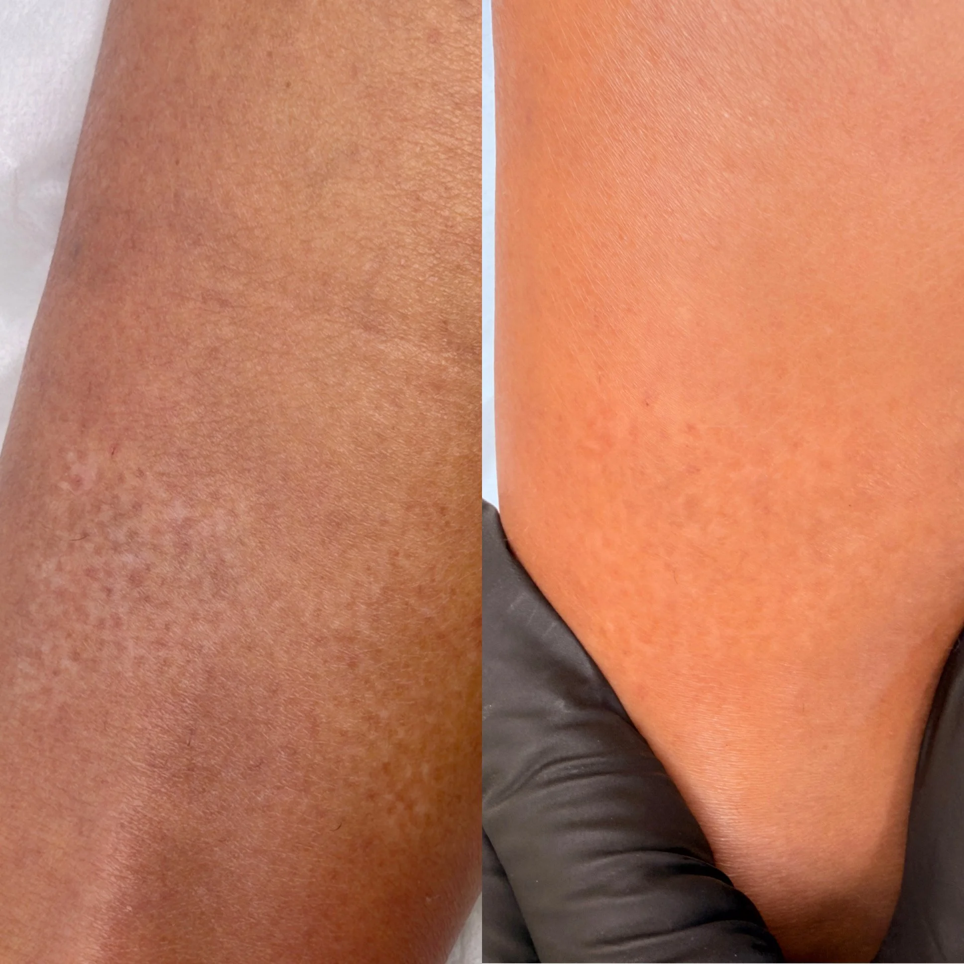 Scar Camouflage Before and After at Kinesis Studio in Fairfield CT