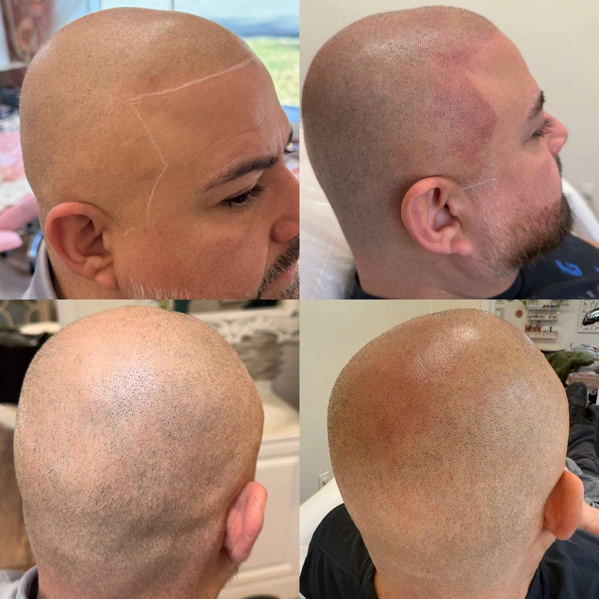 Scalp Micropigmentation Before and After at Kinesis Studio in Fairfield CT
