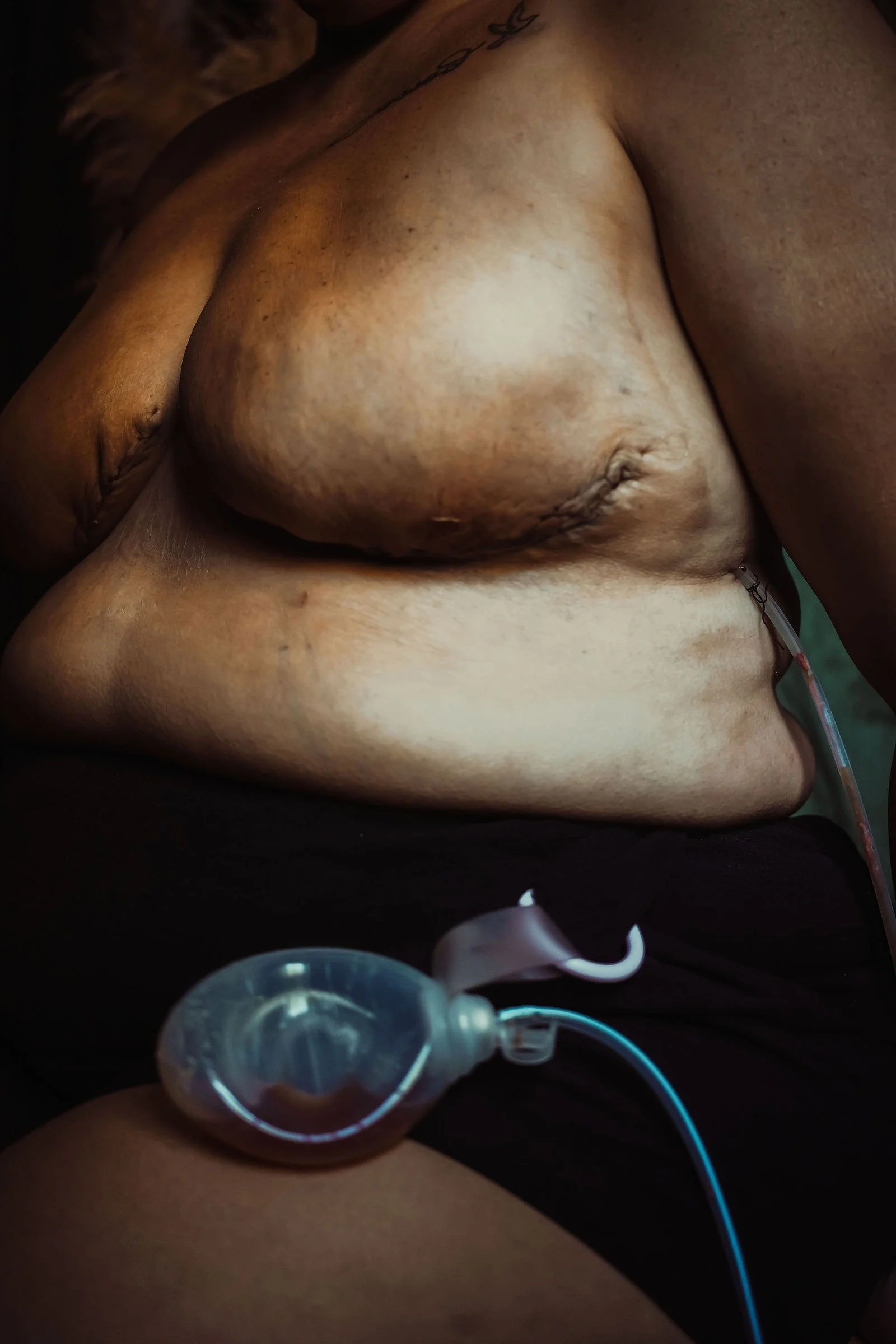 A close-up photo of a woman’s bare chest with a saline IV line attached to her breast, with dark hair and skin tone.