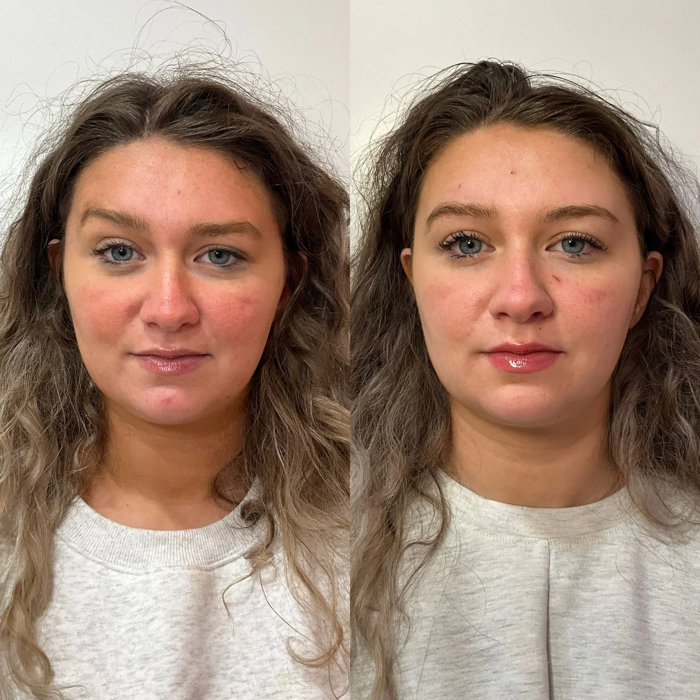 This beautiful patient presented with concerns about asymmetrical eyebrows at rest and during animation. She had no prior history of neurotoxin treatment. 

After a detailed facial assessment, we strategically placed Jeuveau to create harmony between