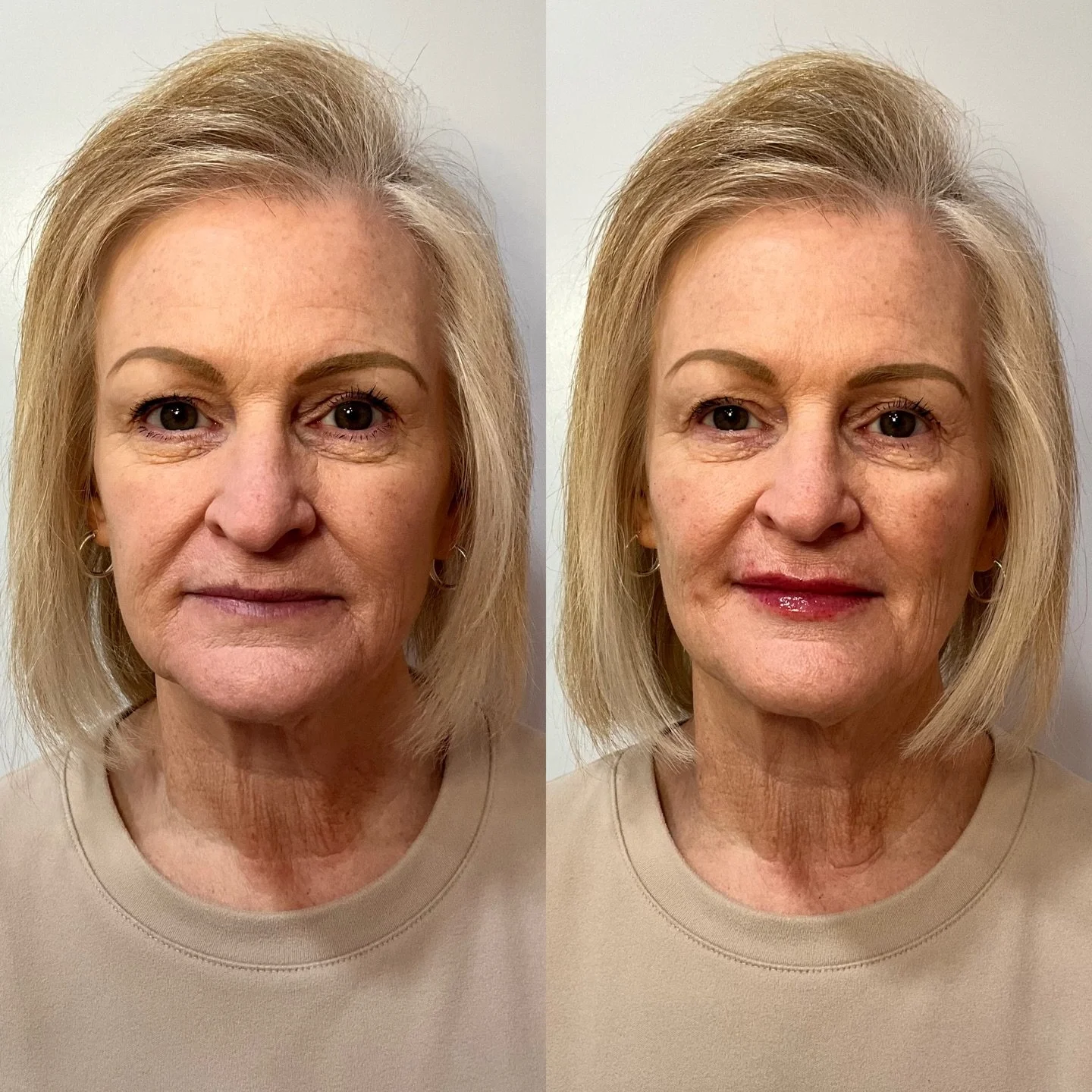 At Beauty and Bloom Aesthetics, we combine medical expertise with an artistic eye to create subtle enhancements that leave you feeling refreshed and confident! 

We restored this patient&rsquo;s natural cheek contour using RHA 4. To complement the ch