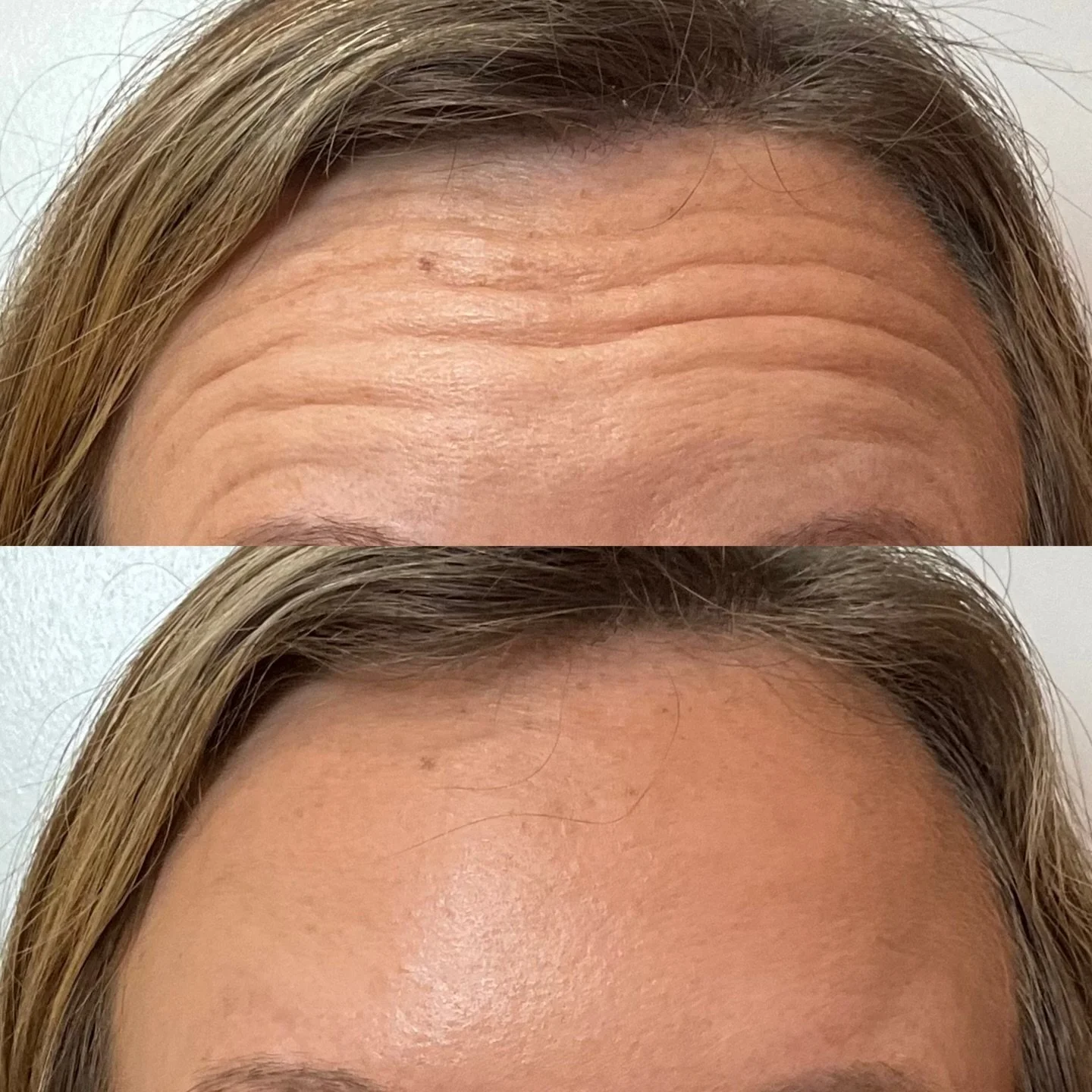 A forehead as smooth as butter all thanks to Dysport 😉

Rachel Treadwell, FNP-C
Beauty and Bloom Aesthetics 
Covington, GA
(706)254-8485

#covingtonga #covingtonsquare #mysticfalls #covingtonmedspa #wrinkles