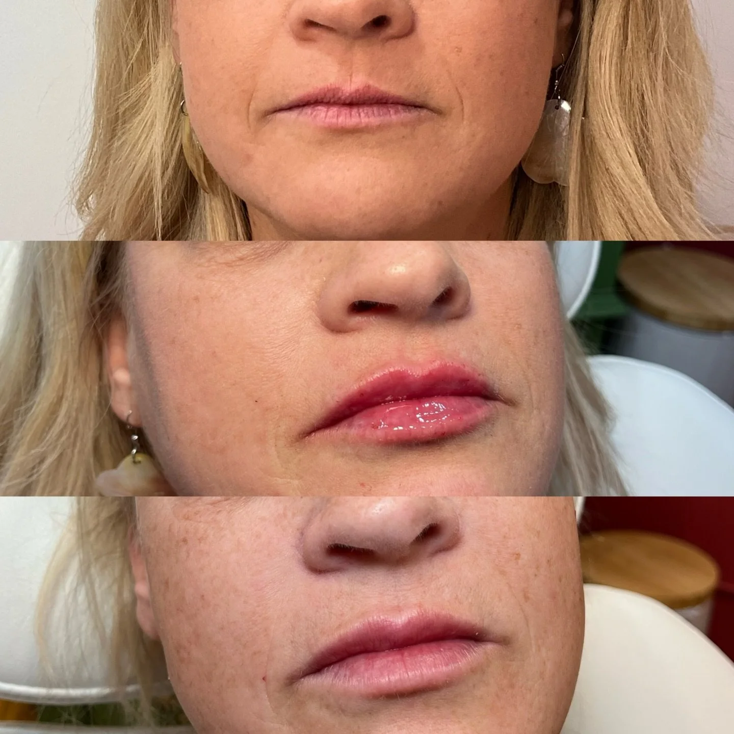 Natural results for a first time lip filler patient! Before &rarr; immediately after &rarr; fully healed 👄

Using hyaluronic acid filler, we enhanced her lip shape, hydration, and fullness&mdash;never overdone, always balanced.

At Beauty and Bloom 