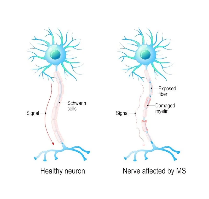 Comparison of a healthy neuron and a neuron affected by multiple sclerosis. The healthy neuron has Schwann cells and a clear signal pathway, while the MS-affected neuron shows exposed fibers, damaged myelin, and disrupted signal transmission.