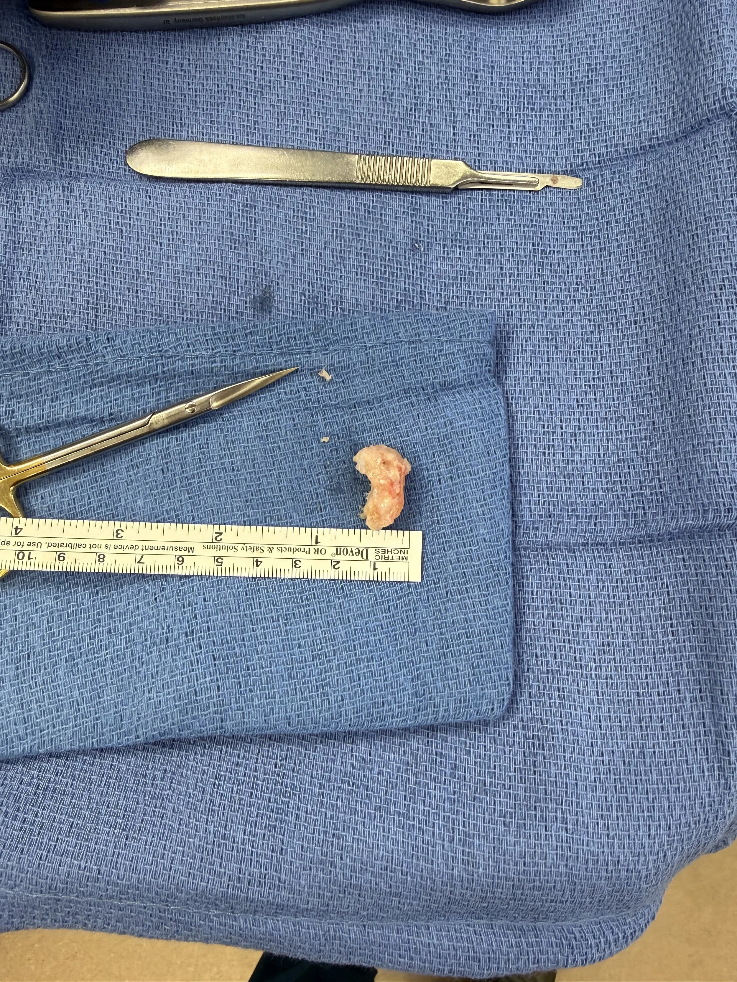 My Surgeon Took a Picture of My Arthritis. Now, I’m going to compare arthritis to marketing.