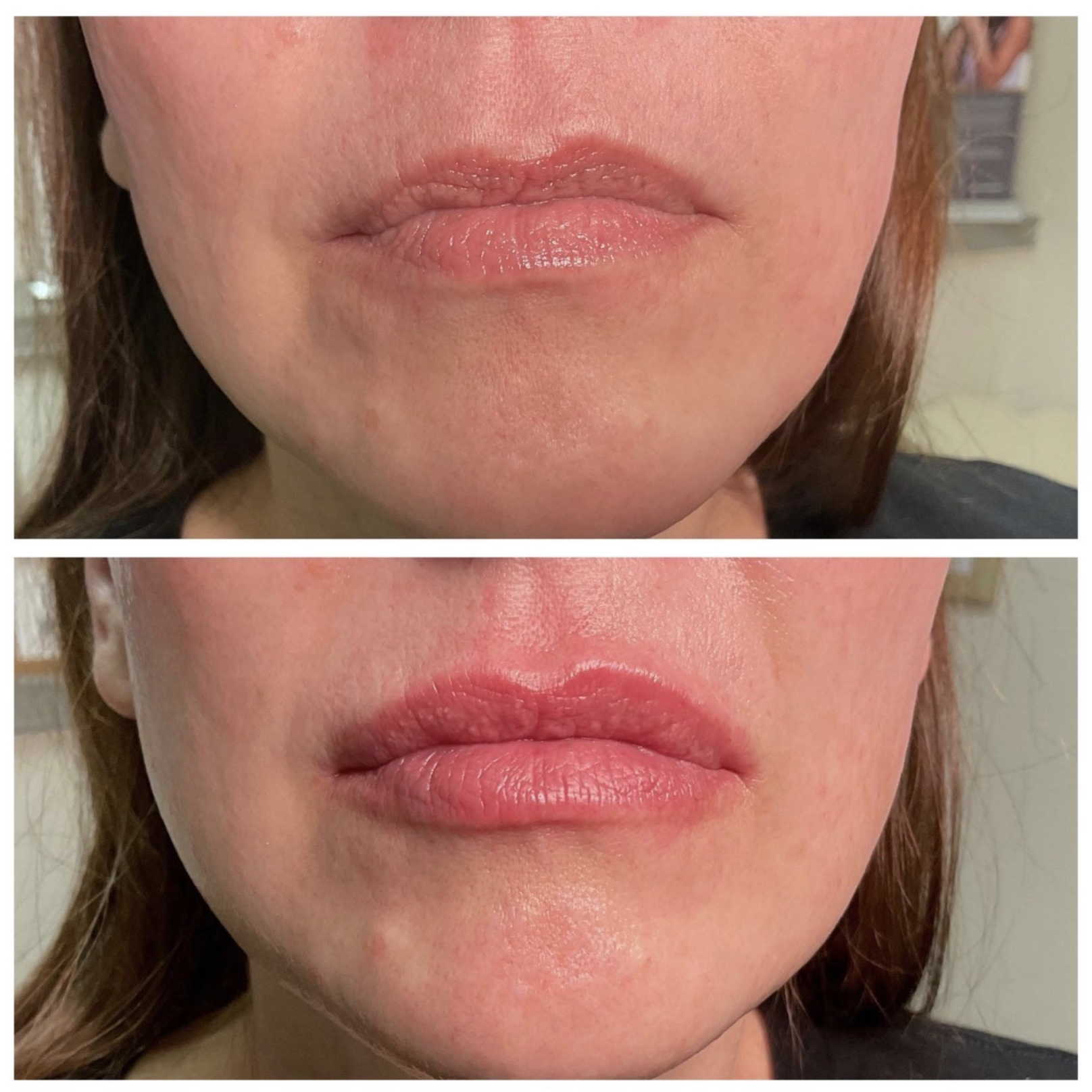 Used 1 syringe of Juvederm ultra 