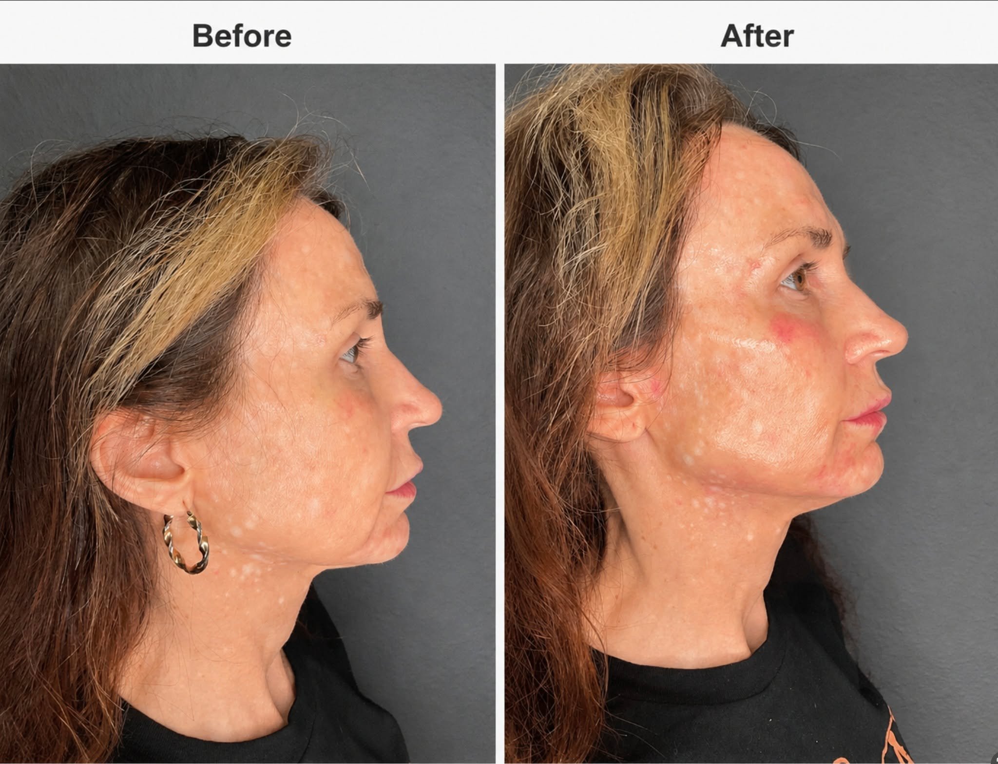 ✨ BEFORE &amp; AFTER TRANSFORMATION ✨

Subtle enhancements can create beautifully balanced, refreshed, and natural-looking results 🤍

For this customized full-face treatment, we used:

💉 1mL Juvederm Volux XC &mdash; Jawline
💉 1.5mL Radiesse &mdas