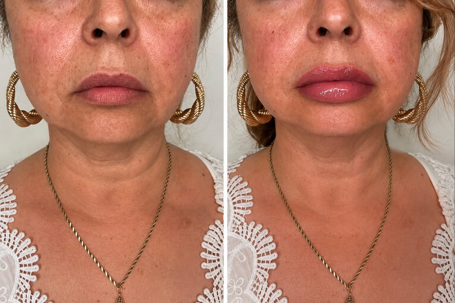 ✨ AGELESS BEAUTY ✨

A subtle enhancement can make such a beautiful difference 🤍
This gorgeous lip transformation was achieved using 1 syringe of Juv&eacute;derm Ultra to restore softness, hydration, shape, and youthful volume to more mature lips &md