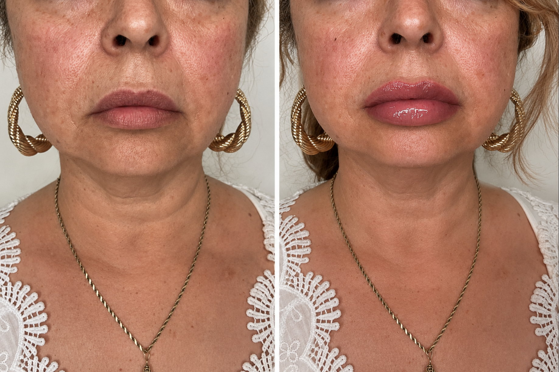 A subtle enhancement can make such a beautiful difference 🤍
This gorgeous lip transformation was achieved using 1 syringe ofJuvéderm Ultra to restore softness, hydration, shape, and youthful volume to more mature lips — while still keeping everythin