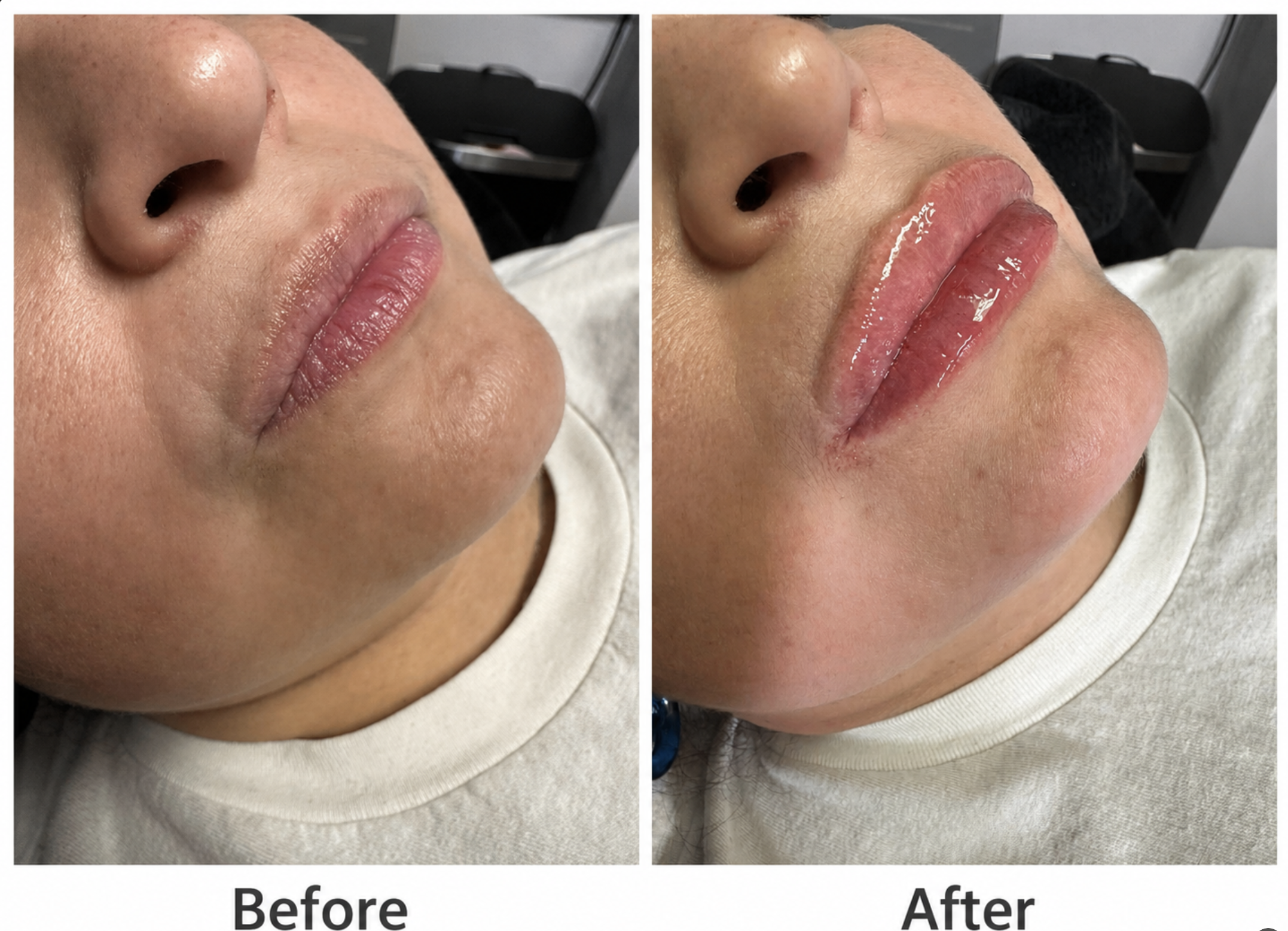 A subtle, beautiful enhancement using 1 syringe of Juvederm Ultra