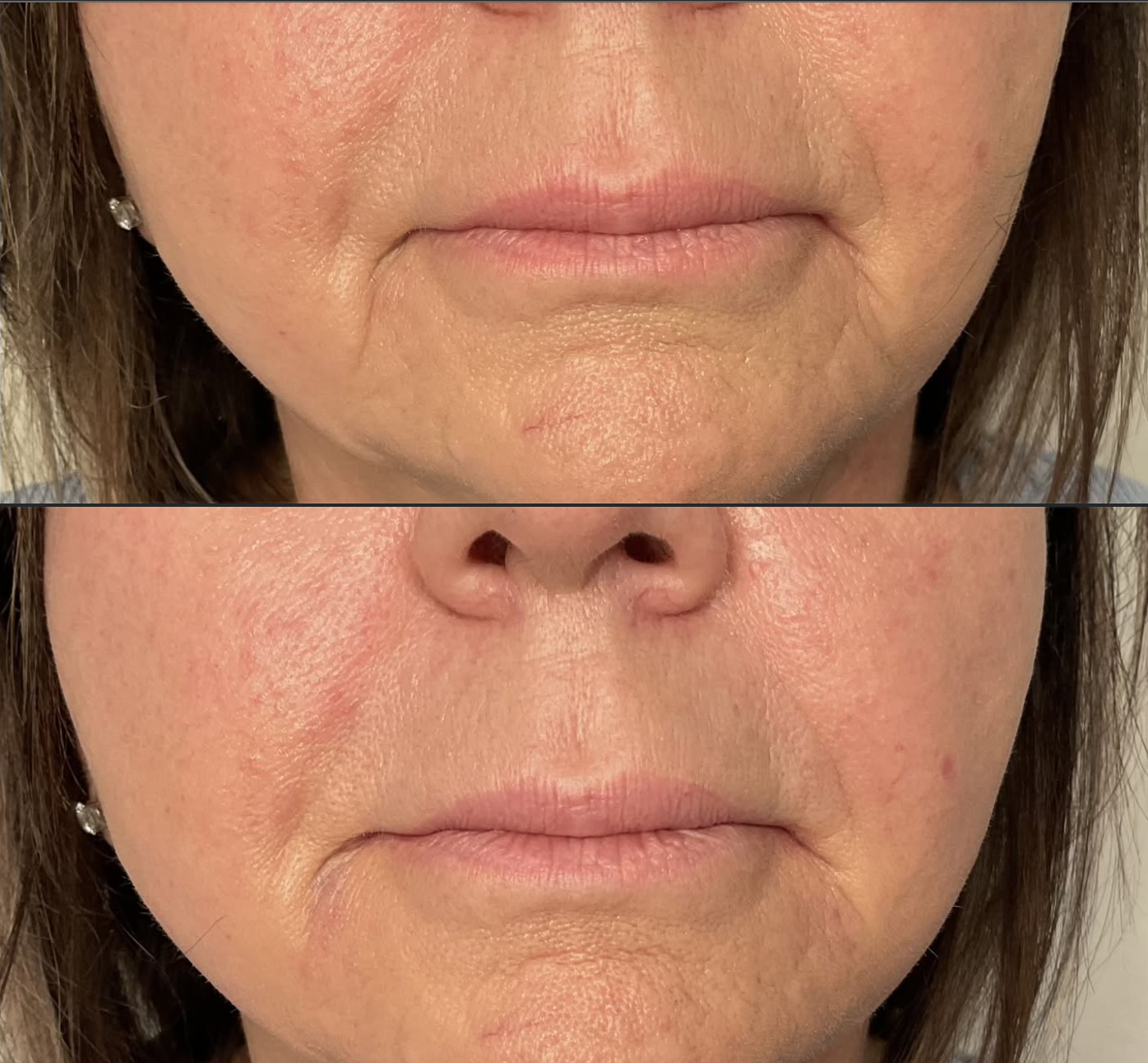 Marionette lines refreshed with 1 syringe of Juvéderm Ultra + a subtle lift using 8 units of Botox to the DAO muscles