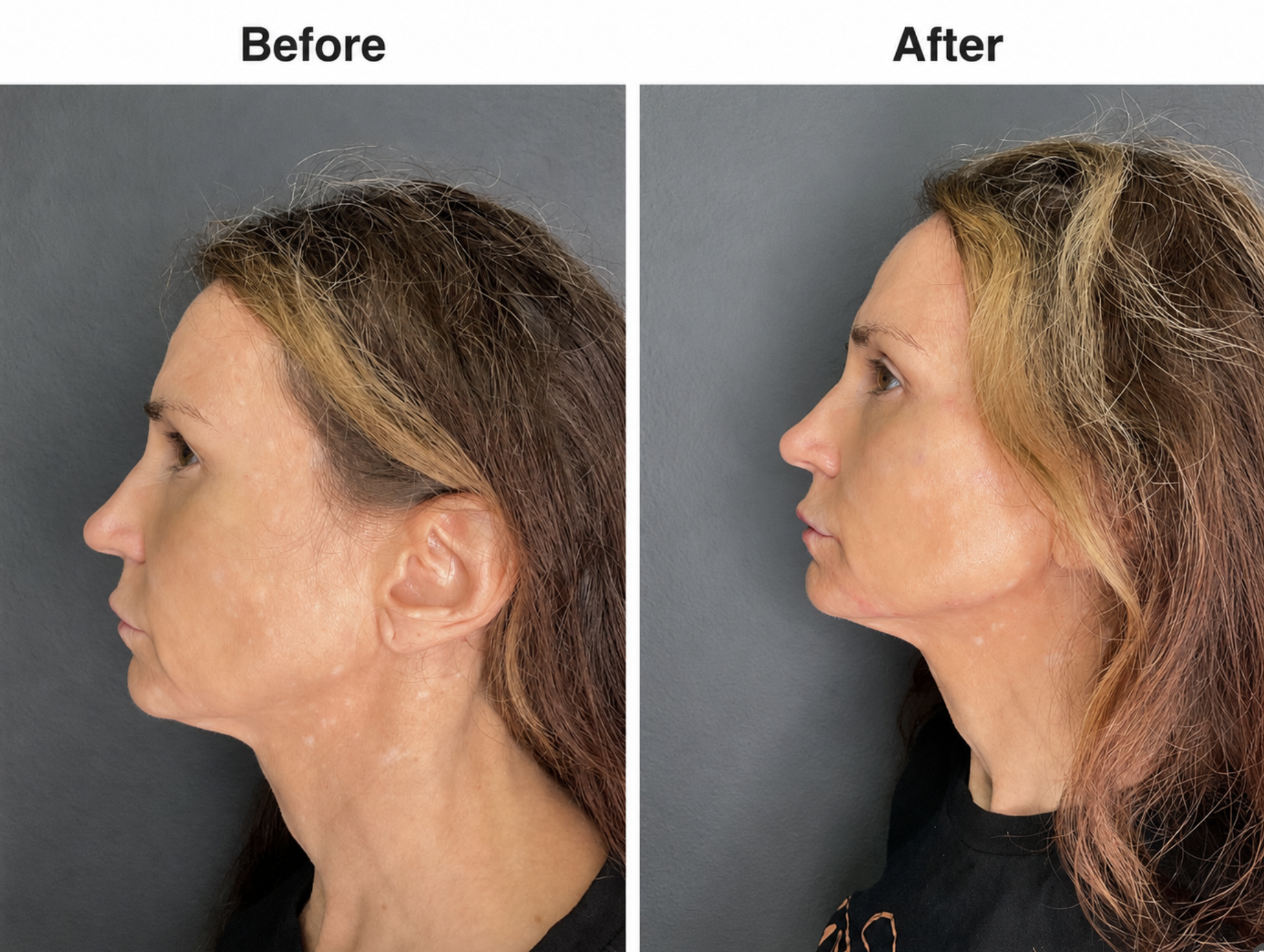 For this customized full-face treatment, we used:
💉 1mL Juvederm Volux XC — Jawline
💉 1.5mL Radiesse — Cheeks
💉 1mL Juvederm Ultra Plus XC
💉 66 Units of Xeomin — (between the brows, forehead, DAO, Crows feet)