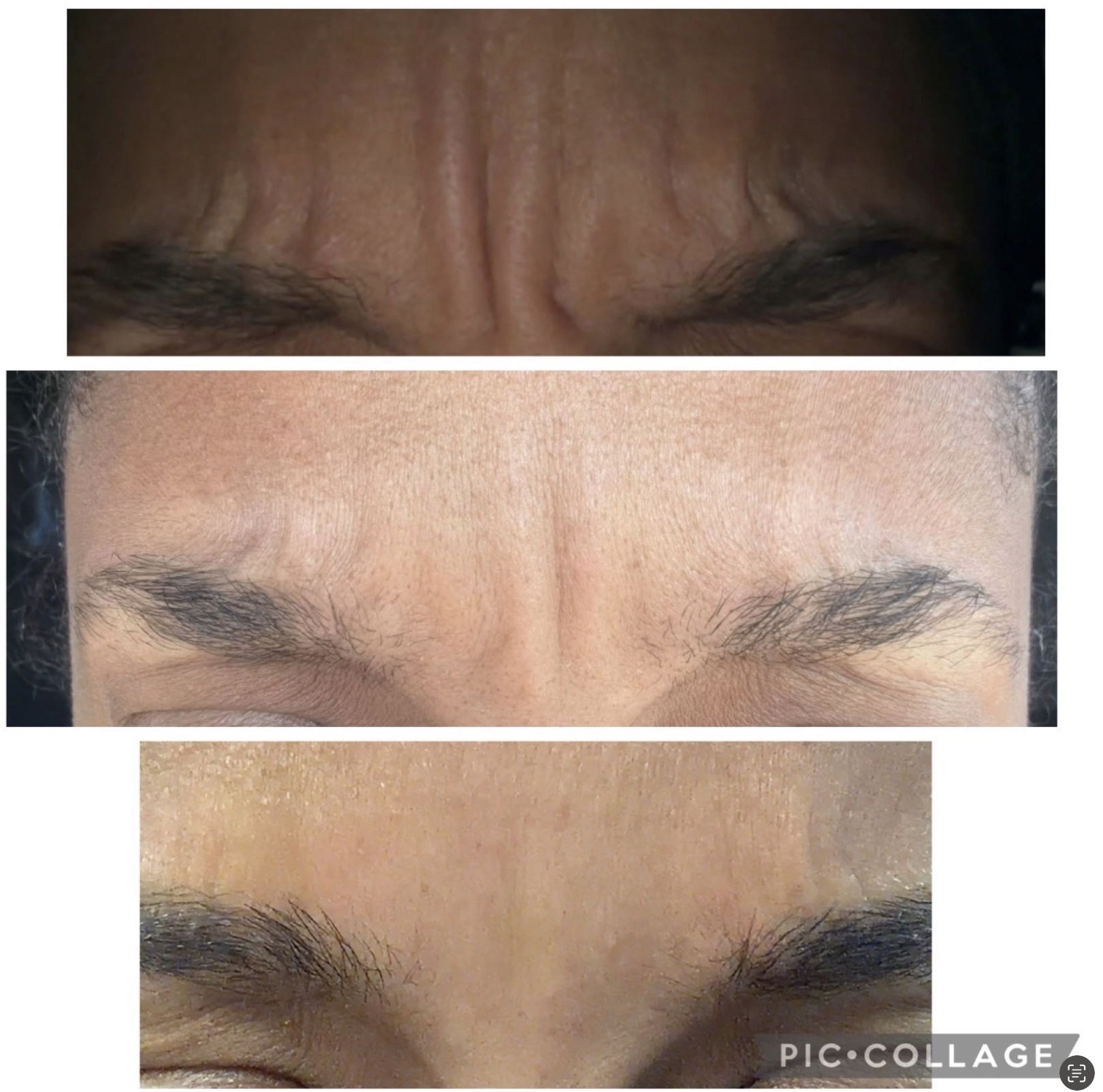 Botox works by relaxing the muscles that cause expression lines and wrinkles. When those muscles relax, the skin smooths out — softening existing lines and helping prevent deeper ones from forming over time. The goal is never “frozen”… it’s refreshed