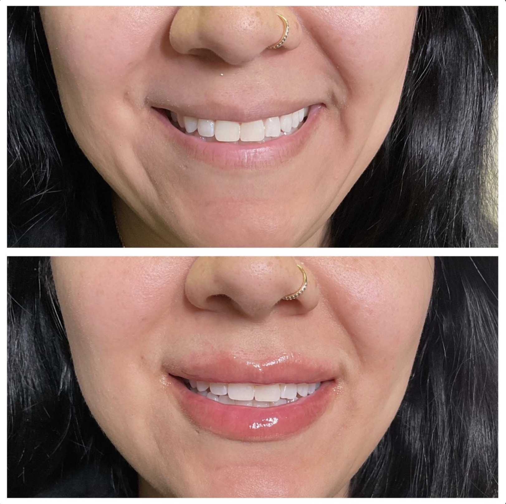 I had the pleasure of enhancing my client's lips today using 1ml of Juvéderm, and I couldn't be happier with the results! 