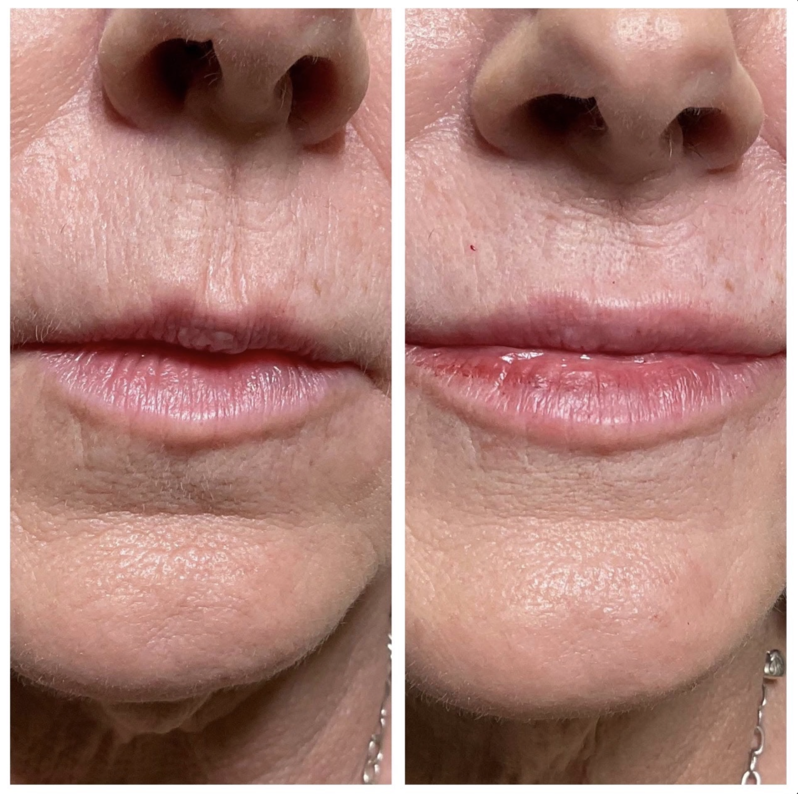 On this beautiful client I used 1  syringe of Juvederm Volbella in peri-oral lines and 1 syringe of Juvederm Ultra
