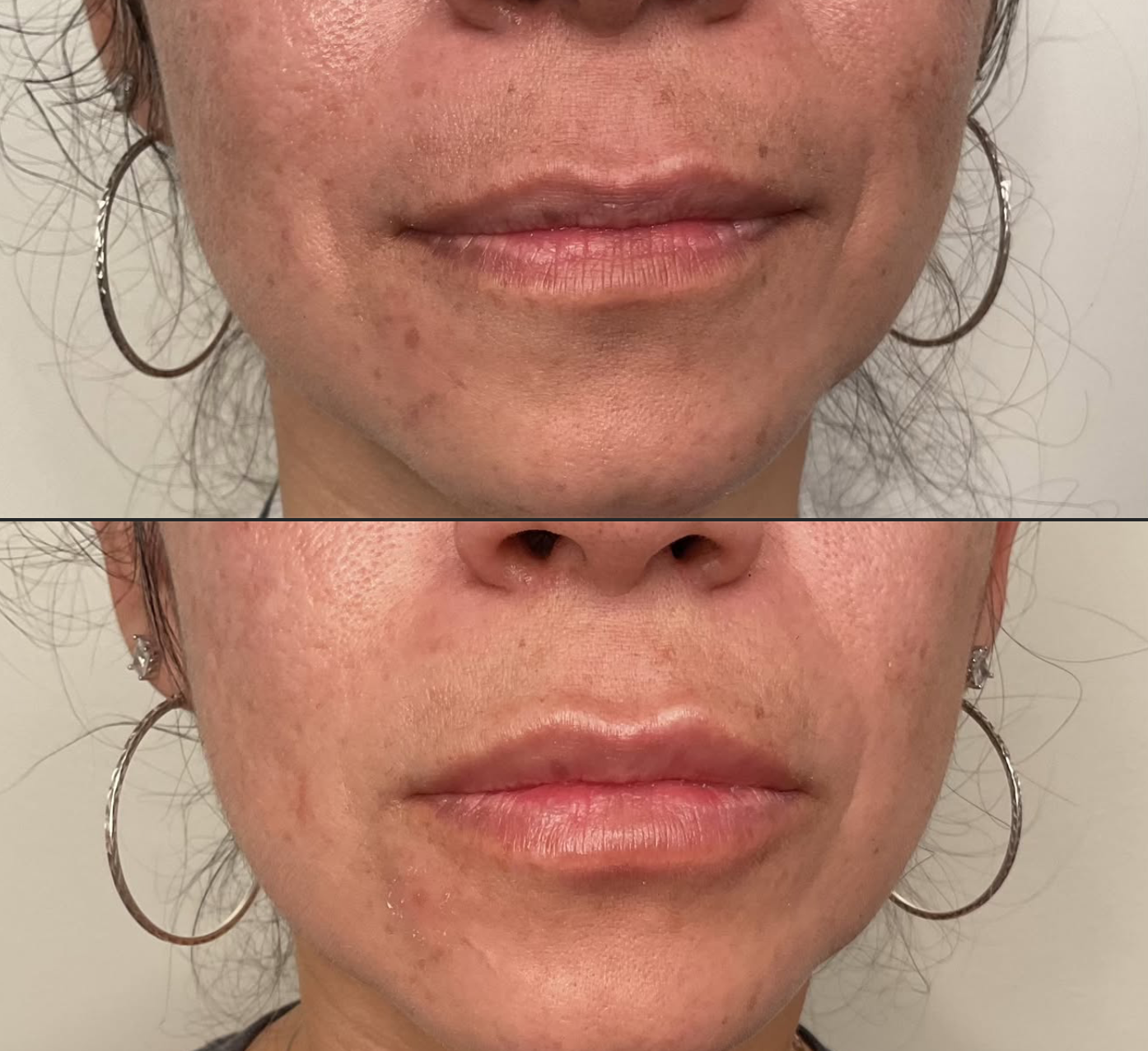 Treatment: Juvéderm Ultra
Amount: Half Syringe
Follow-Up: 2 Weeks Healed 