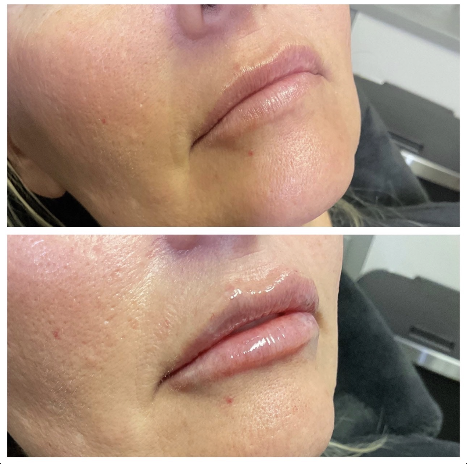 Used 1/2 syringe of Juvederm ultra in lips!