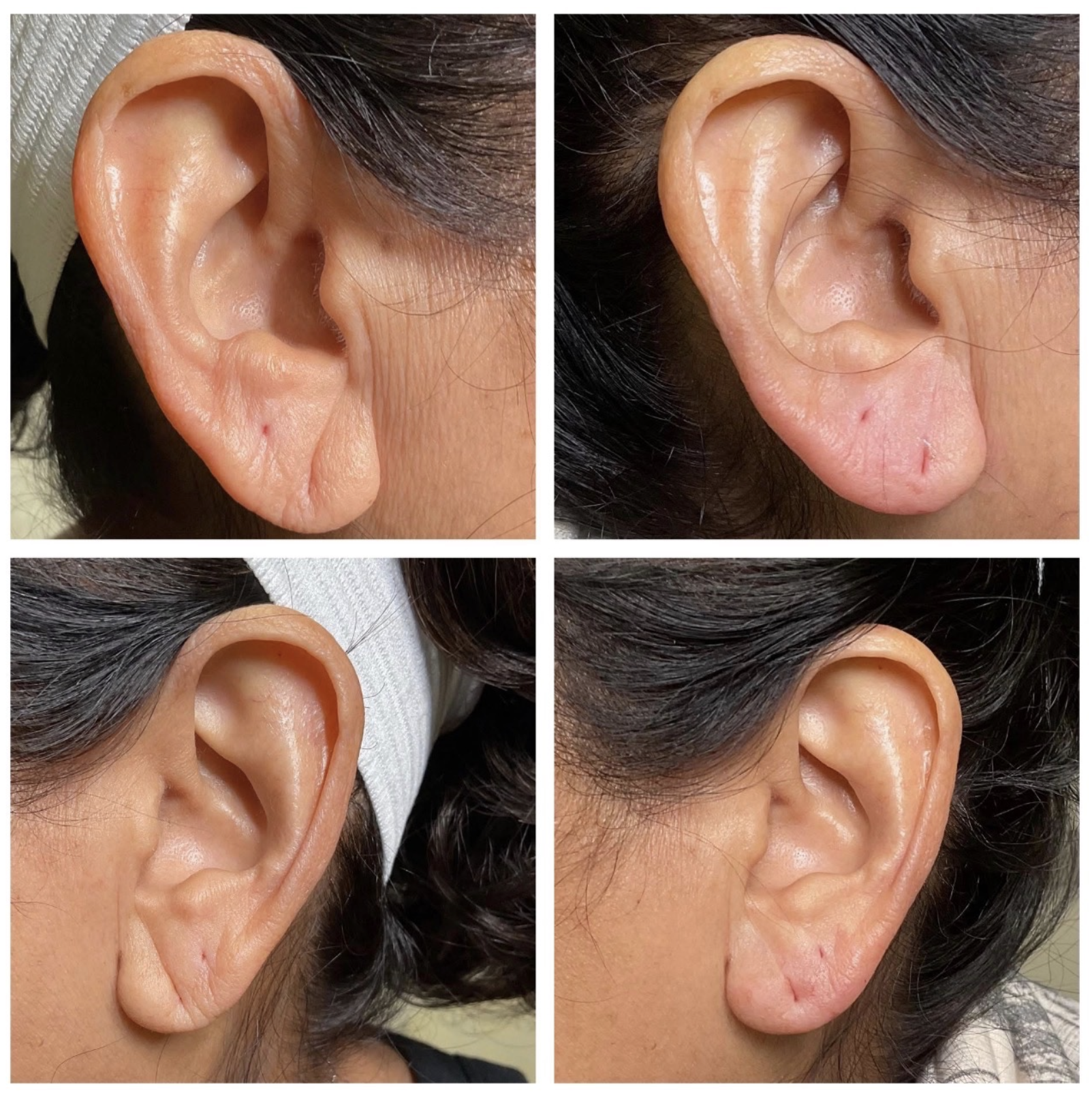 I used 1/2 syringe of Juvederm Ultra in ear lobes 