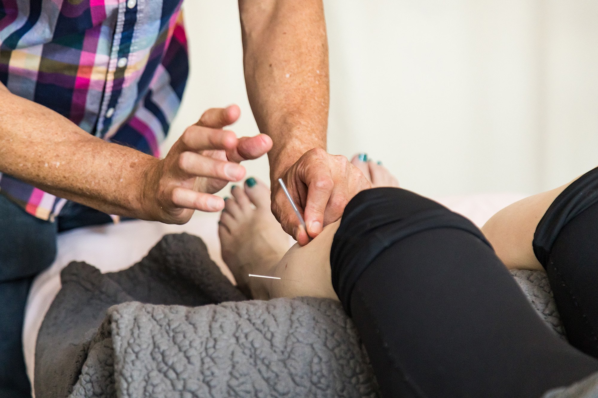 Person receiving acupuncture treatment on the back by an acupuncturist in a clinical setting.