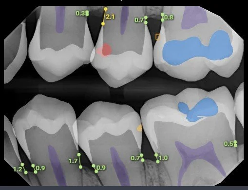 Advanced AI X-rays that show cavities.