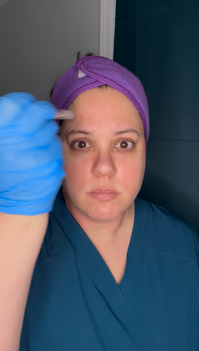 microneedling, nanoneedling, graceful again, anti-aging