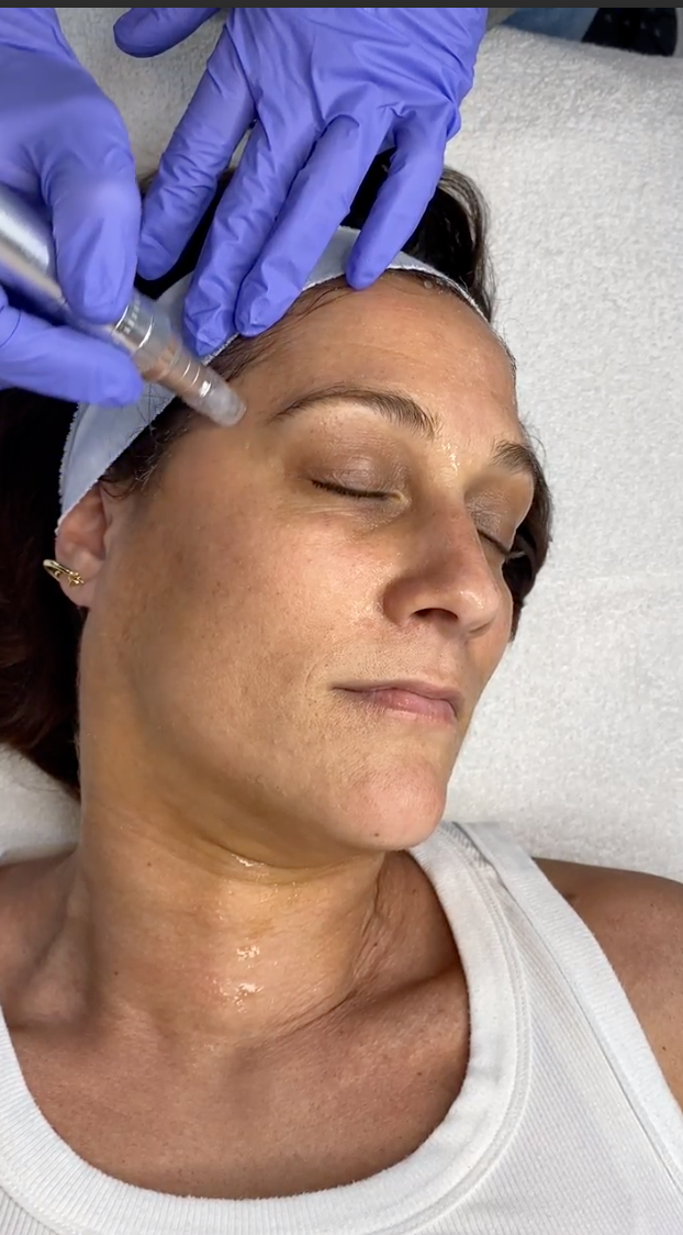 Microneedling: What to do before and after your treatment.