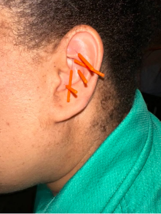 NADA, ear acupuncture
