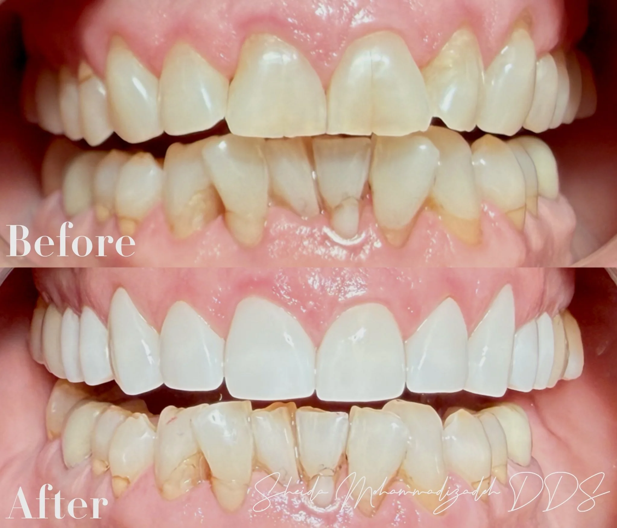 Beautiful smile cosmetic dentistry Riverside CA veneers and whitening
