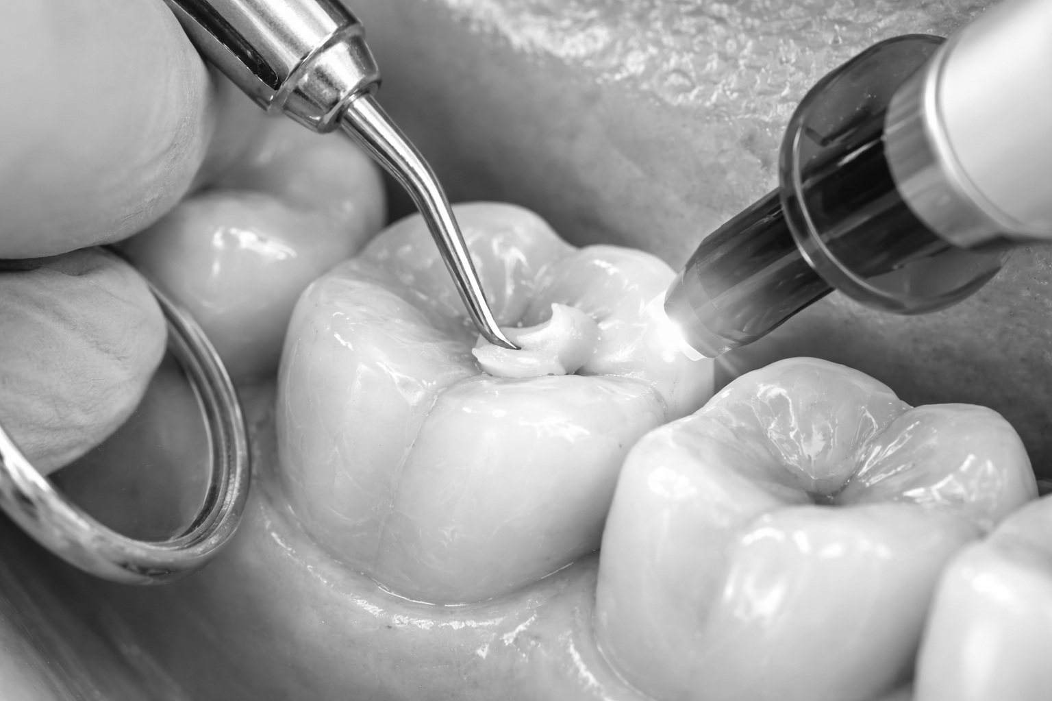 Restorative dentistry Riverside CA cavity treatment and dental repair