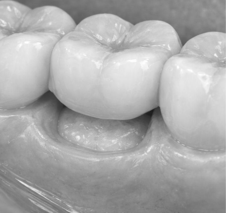 Bridges treatment Riverside CA Orangecrest Family Dental