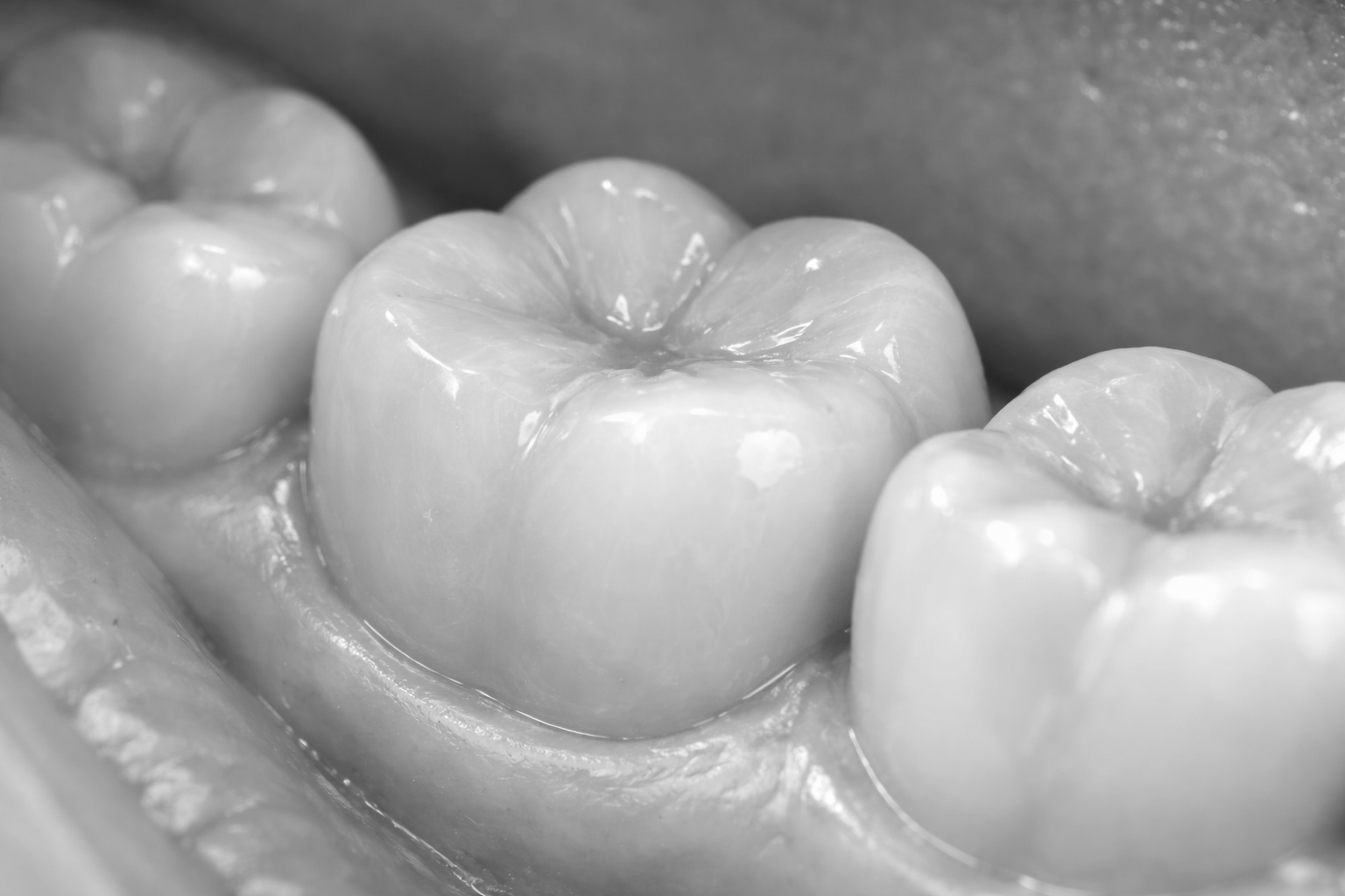 Crowns Riverside CA Orangecrest Family Dental