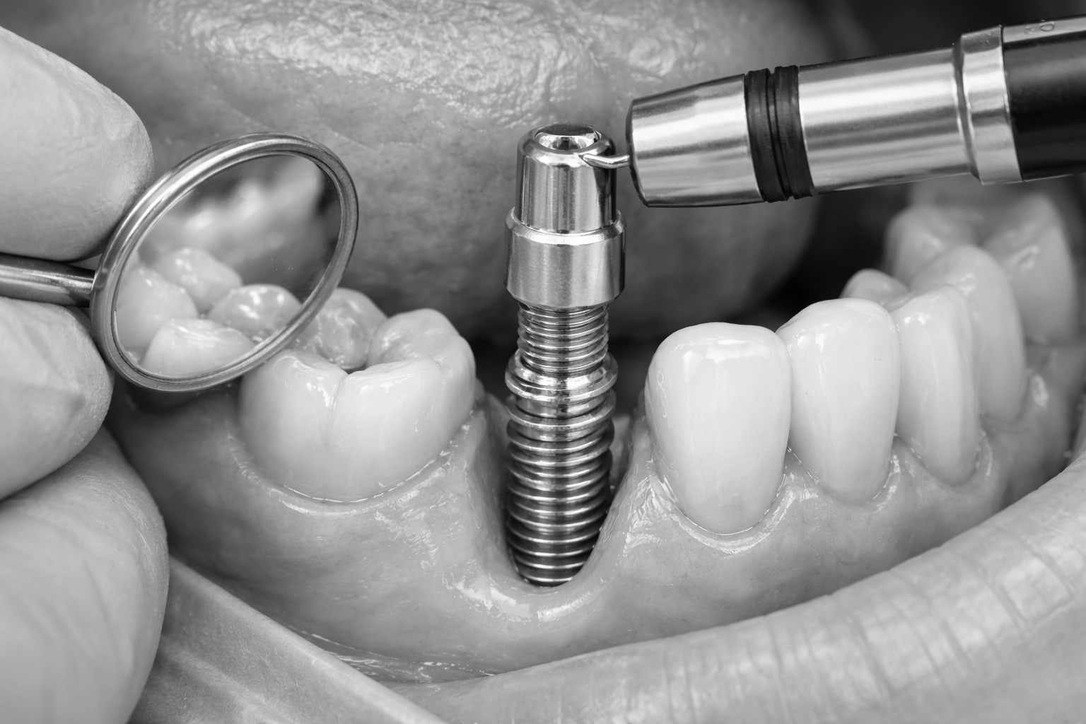 Dental implants Riverside CA permanent tooth replacement Orangecrest Family Dental