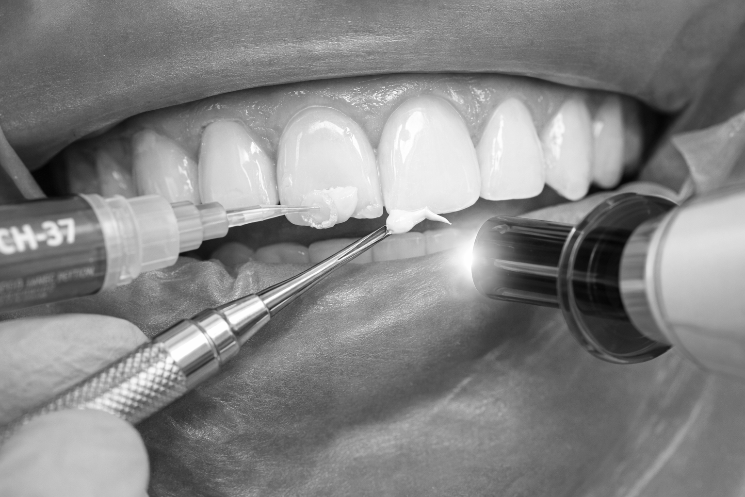 Bonding treatment Riverside CA Orangecrest Family Dental