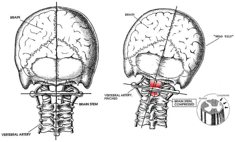 What is Upper Cervical Chiropractic?