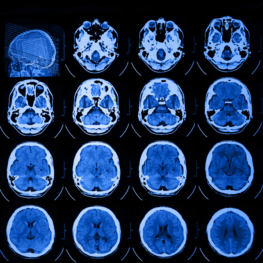 Series of brain MRI scans in shades of blue, showing different cross-sections of the brain from various angles.