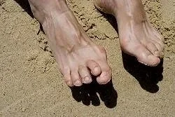 hammertoe treatment boyton beach and loxahatchee podiatrist