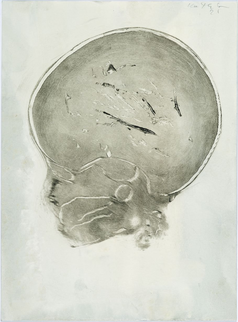 A black and white medical scan showing a human skull from a side view.