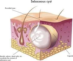 Sebaceous Cysts in Dogs: Causes, Symptoms, Diagnosis, and Treatment