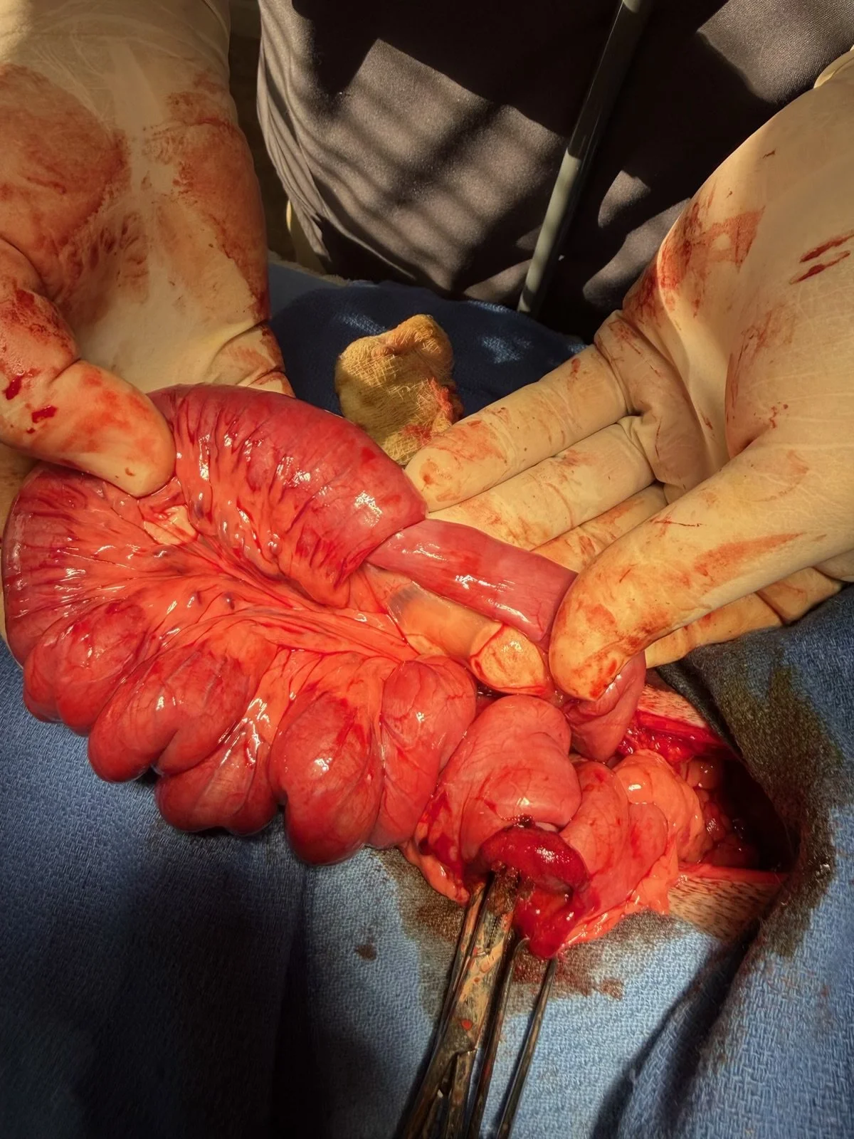 Gastric/ Small intestinal Foreign body removal