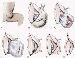surgery repair inguinal hernia