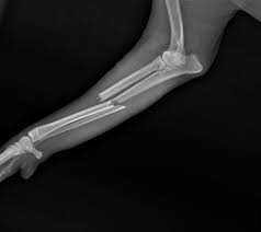 bone fracture dog