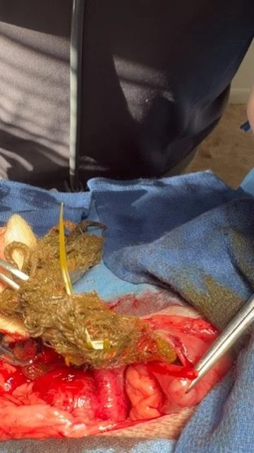 foreign body surgery dr hart