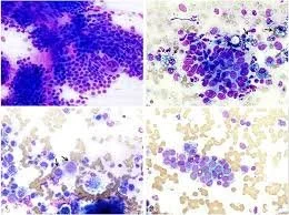 fna of tumor