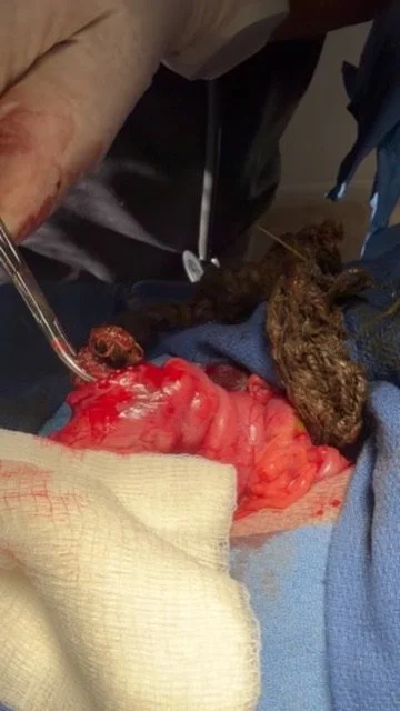 foreign body surgery