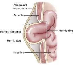 hernial