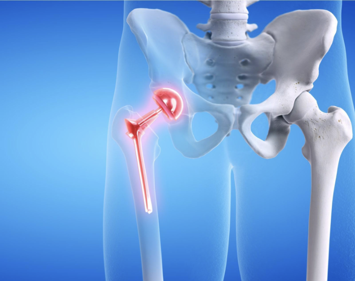Hip Replacement Wait Times in Canada vs Private Surgery in Mexico