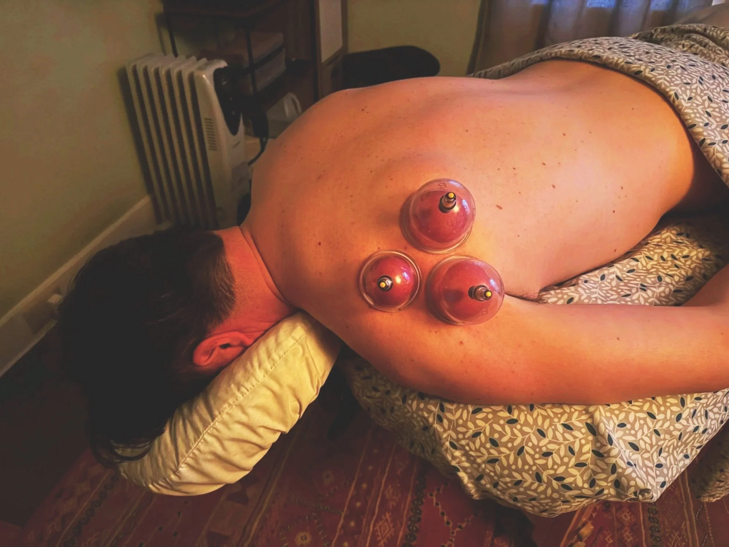 Client receiving Cupping in Portland