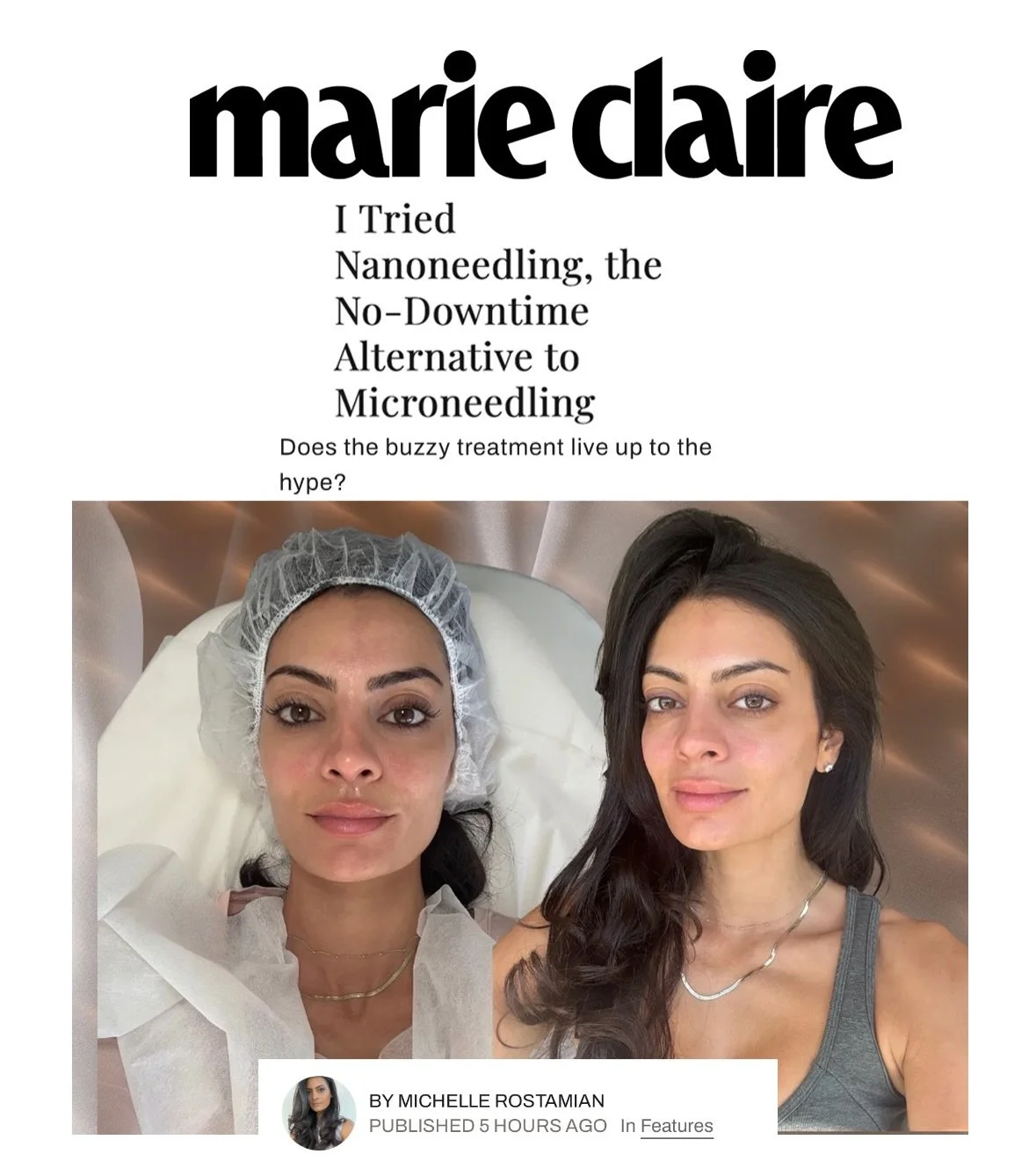 Our nanoneedling treatment at Beyond Facials Santa Monica has been featured in Marie Claire 🖤

Huge thank you to Michelle @readysetglamourr for the honest, thoughtful review of our top procedure &mdash; nanoneedling combined with exosomes + PDRN for